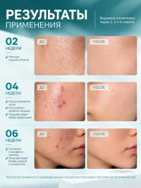 Анти-акне крем-флюид