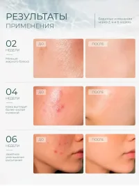 Анти-акне крем-флюид